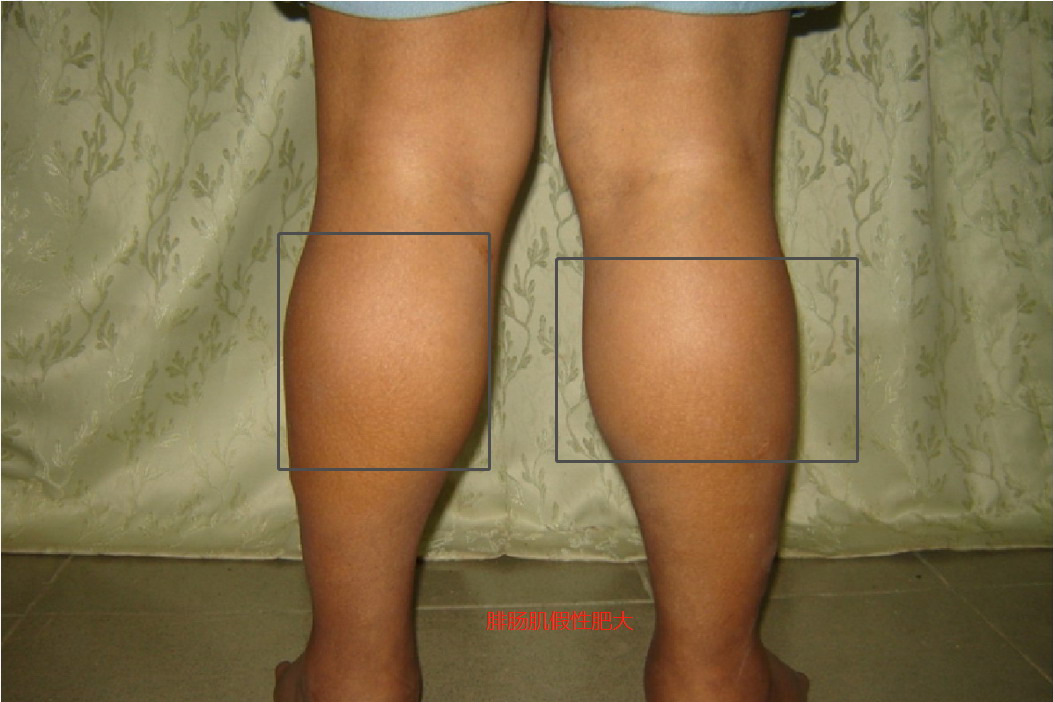 腓肠肌假性肥大图片