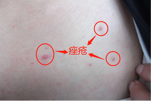 胸口痤疮图片