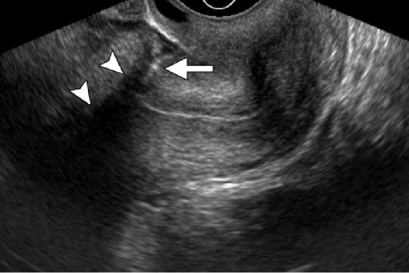 子宫瘢痕B超示意图