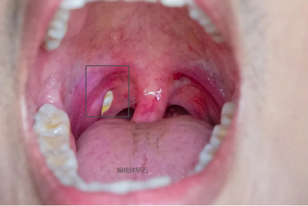 扁桃体结石图片
