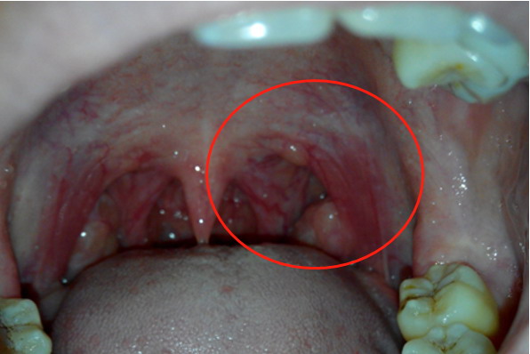 扁桃体发炎图片