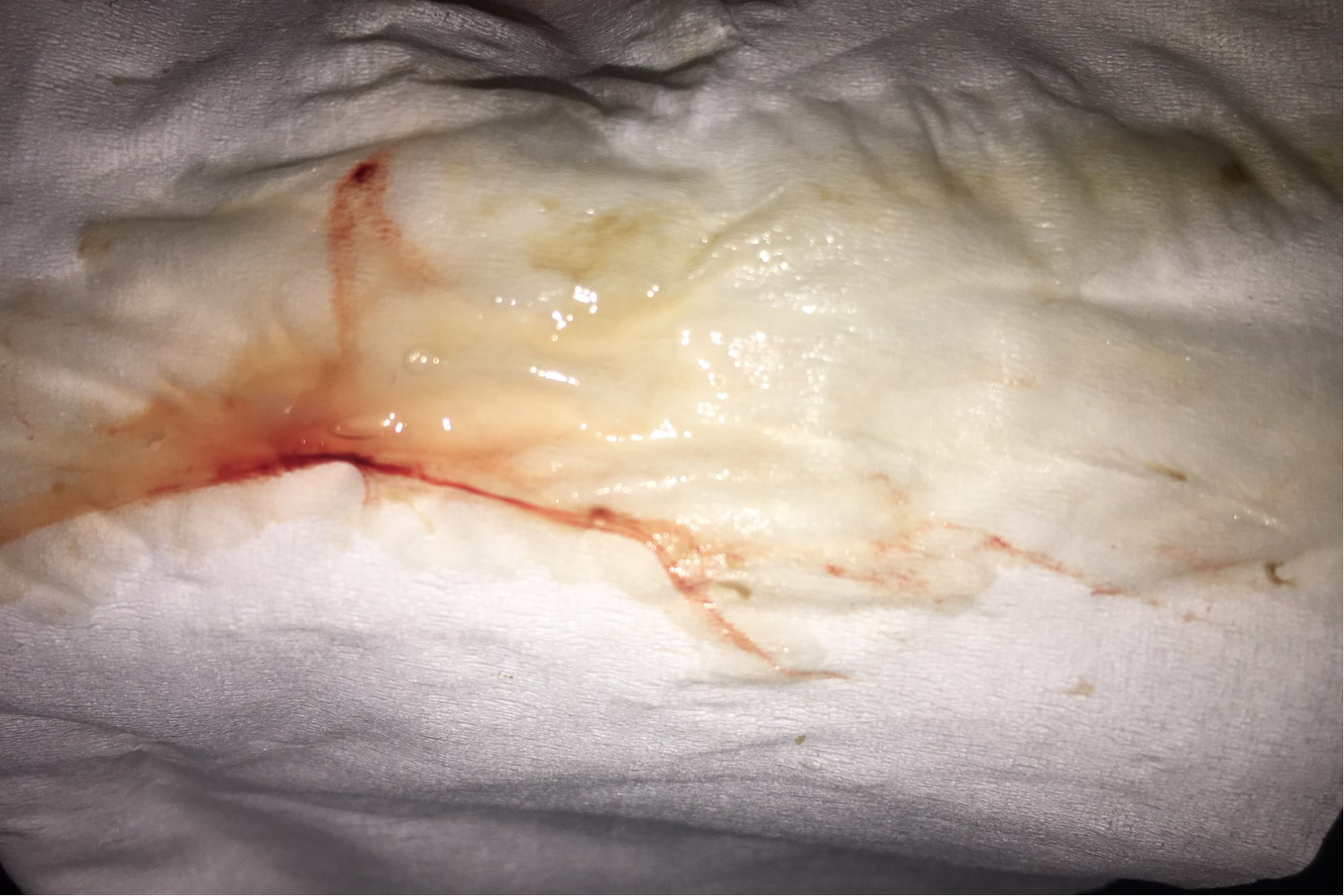 白带鼻涕状带血丝图片